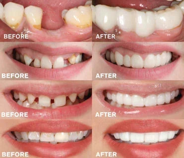 Prótesis dental de clip | Diseño que se apoya en los dientes, sin adhesivo | Para una sonrisa radiante sin visita al den
