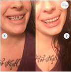 Prótesis dental de clip | Diseño que se apoya en los dientes, sin adhesivo | Para una sonrisa radiante sin visita al den